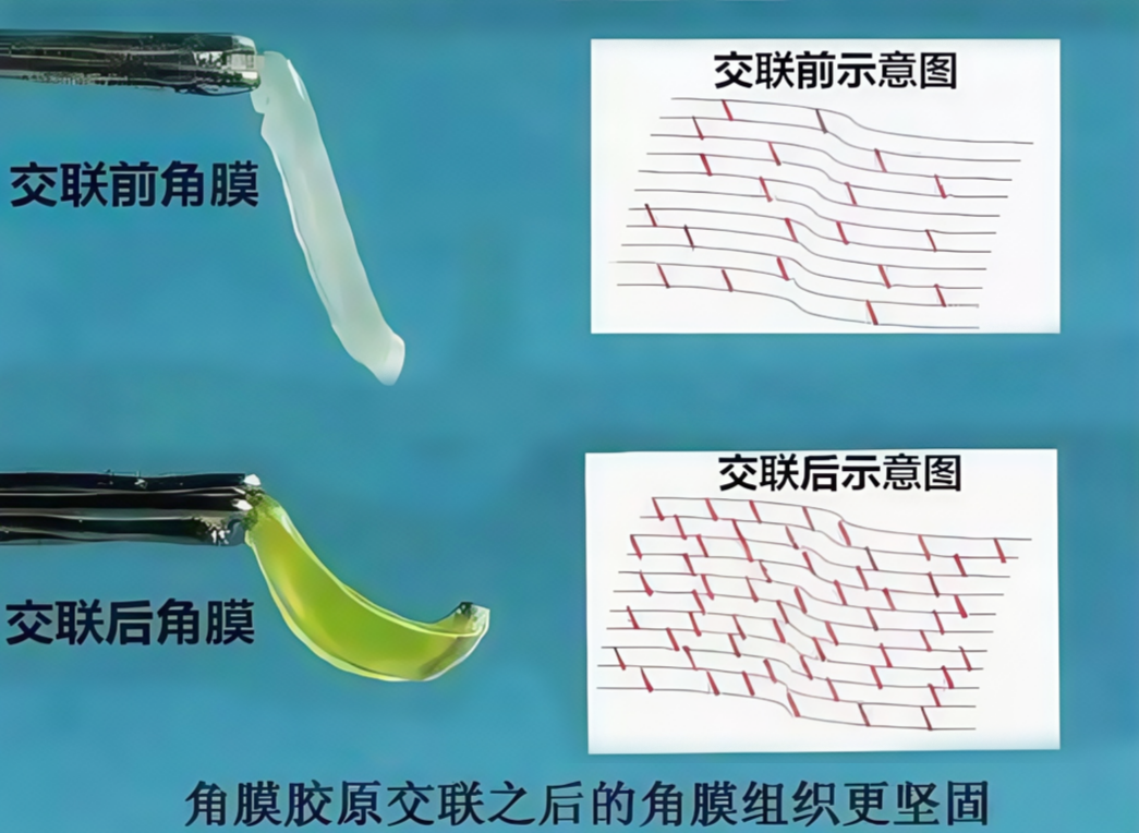 交联一手术前后 交联一手术前后